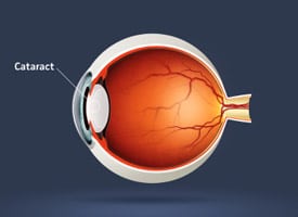 p cataracts